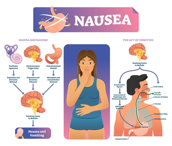 Nausea vector illustration. Labeled medical vomiting explanation scheme. — Stock Illustration Nausea vector illustration. Labeled medical vomiting explanation scheme. Royalty Free Stock Vectors