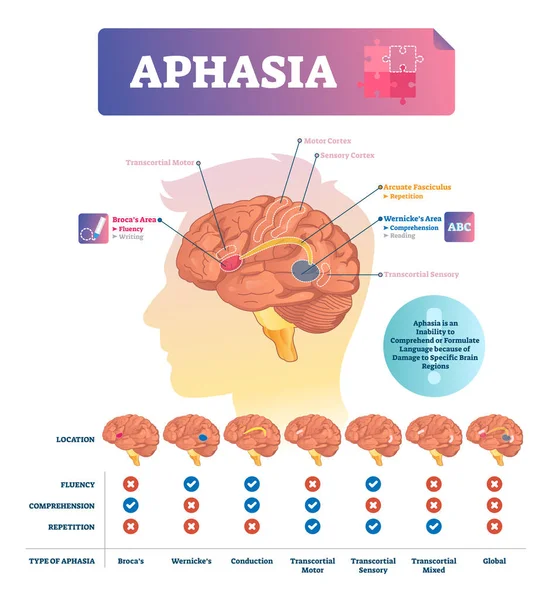 Aphasia vector illustration. Labeled educational scheme with brain disorder — Stock Vector