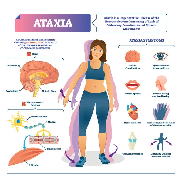 Ilustración vectorial de taxia. Esquema de trastorno cerebral movimiento médico etiquetado . — Vector de stock