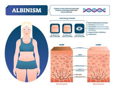 Albinizm vektör çizim. Etiketli tıbbi melanin pigment kaybı düzeni.