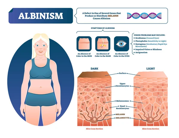 Ilustração vetorial do albinismo. Esquema de perda de pigmento de melanina médica rotulada . —  Vetores de Stock