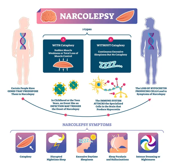 Ilustración del vector de narcolepsia. Infografía de la enfermedad de fuerza muscular etiquetada — Vector de stock