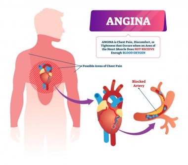 Angina vektör Illustration. Etiketli tıbbi göğüs ağrısı ve kalp sorunu.