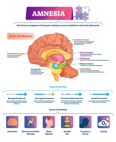 Amnesia vector illustratie. Gelabeld Brain geheugenverlies ziekte soorten regeling — Stockvector