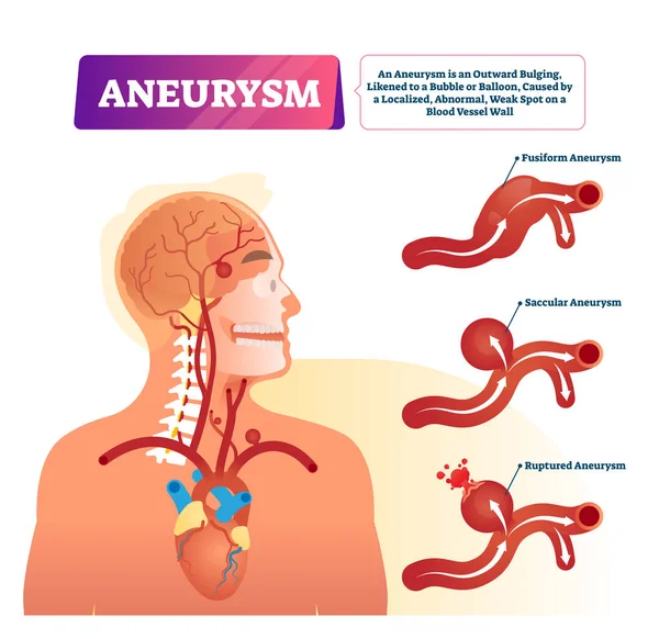 Aneurysm vector illustration. Labeled medical outward bulging vessel scheme — Stock Vector