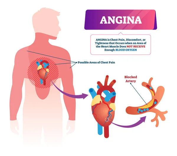 Ilustración del vector angina. Dolor de pecho y problemas cardíacos . — Archivo Imágenes Vectoriales