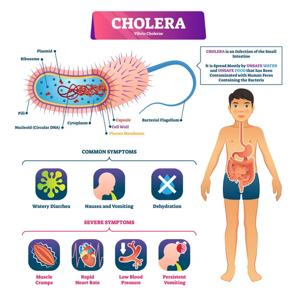 Ilustração vetorial da cólera. Estrutura de infecção rotulada e esquema de sintomas — Vetor de Stock
