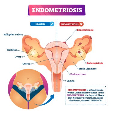 Endometriozis vektör illüstrasyonu. Etiketli rahim jinekoloji si
