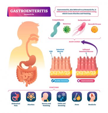 Gastroenterit vektör illüstrasyonu. Etiketli mide iltihabı şeması