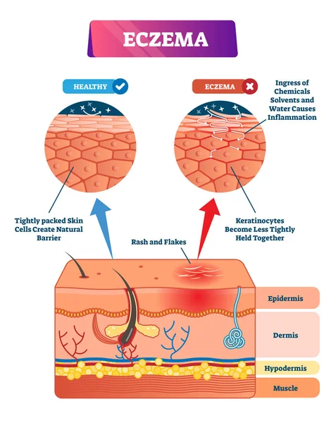 Eczema vector ilustración. Estructura anatómica etiquetada esquema comparativo — Vector de stock