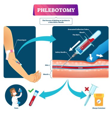 Phlebotomy vector illustration. Labeled veins blood samples process scheme. clipart