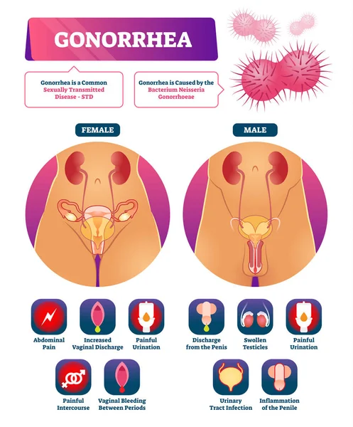 Ilustración vectorial de gonorrea. Lista de síntomas de explicación de la enfermedad de ETS etiquetada — Vector de stock