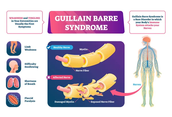 Ilustración vectorial del síndrome de Guillain Barre. Esquema de enfermedad muscular etiquetada . — Archivo Imágenes Vectoriales