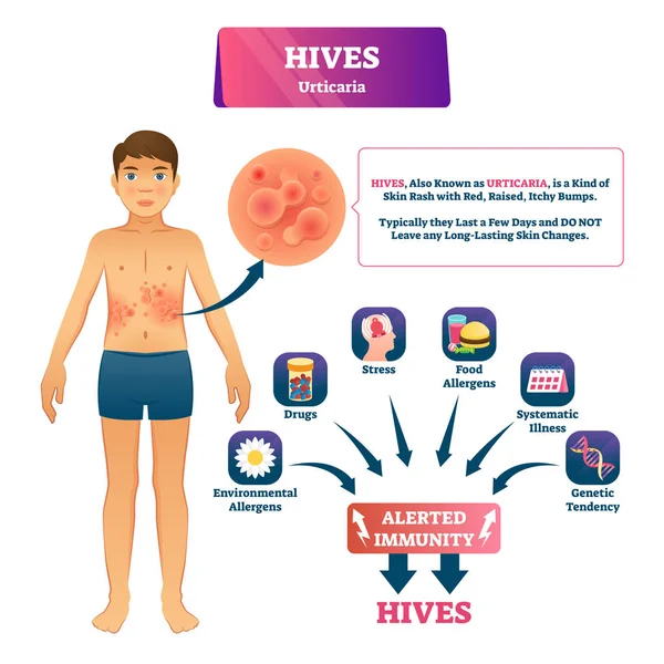 Illustrazione vettore orticaria orticaria. Schema di spiegazione rash cutaneo etichettato . — Vettoriale Stock