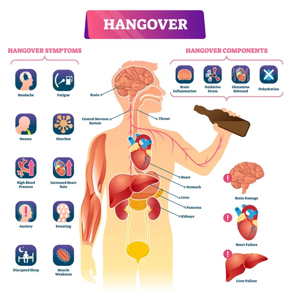 Hangover vector illustration. Labeled alcohol sickness explanation scheme. — Stock Vector