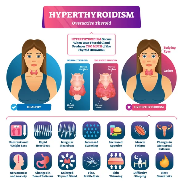 Hipertiroidi vektör illüstrasyon. Etiketli tıbbi tiroid bezi hastalığı. — Stok Vektör