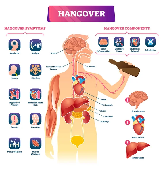 Hangover vector illustration. Labeled alcohol sickness explanation scheme. — Stock Illustration Hangover vector illustration. Labeled alcohol sickness explanation scheme. Stock Vector