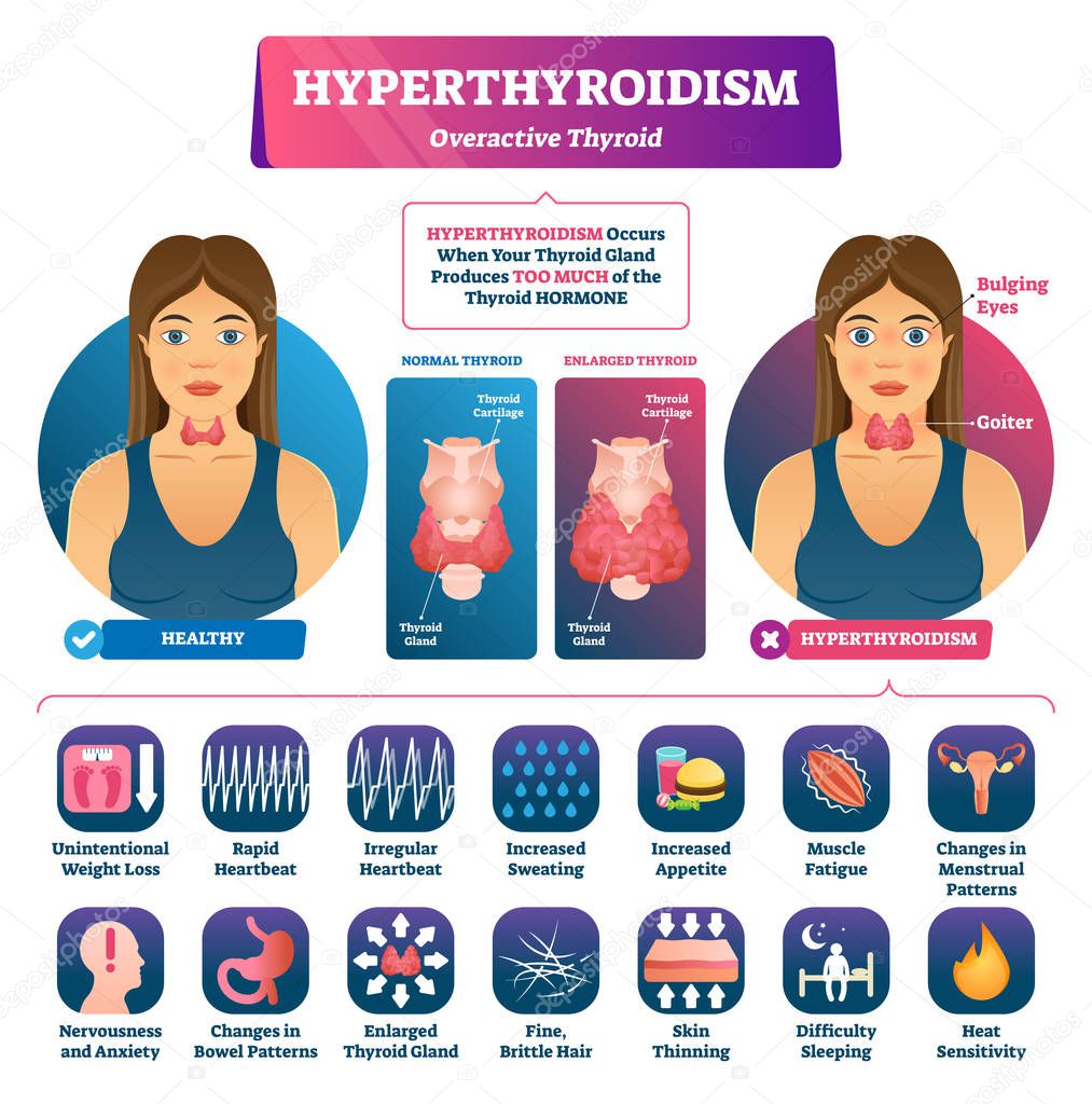 Hyperthyroidism vector illustration. Labeled medical thyroid gland disease.