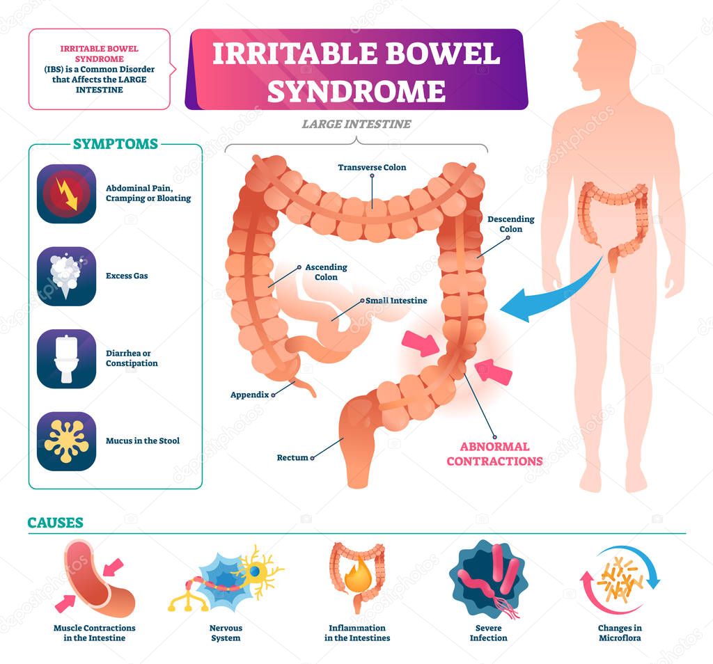 Irritable bowel syndrome vector illustration. Labeled medical disease graph