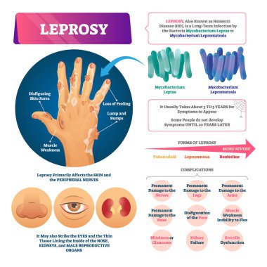 Leprosy vector illustration. Labeled medical bacterial infection disease. clipart