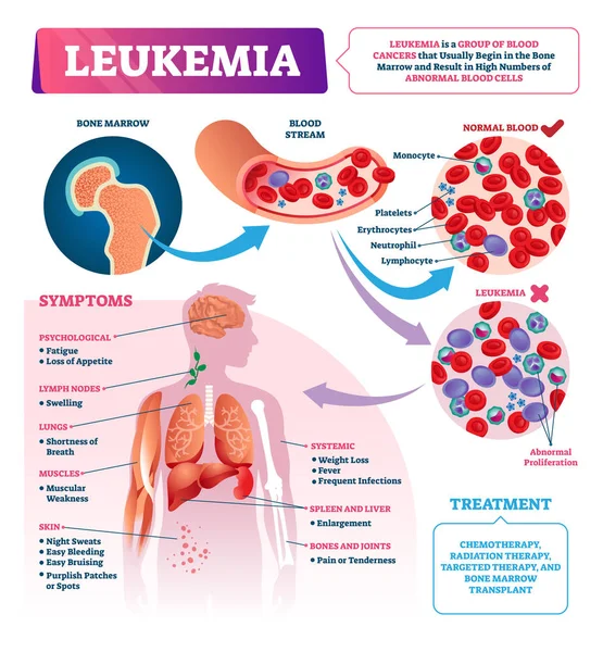 Illustrazione vettoriale della leucemia. Infografica sul cancro del sangue educativo etichettata . — Vettoriale Stock