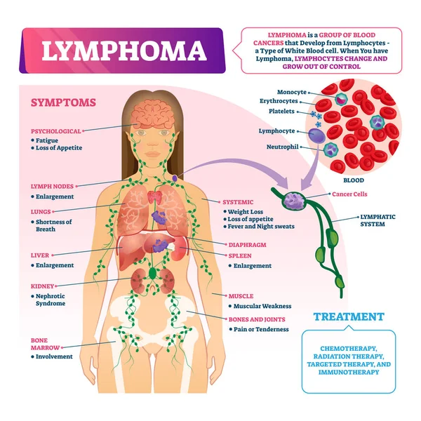 Lymphoma vektor illusztráció. Címkével ellátott oktatási vérrák típusú rendszer. — Stock Vector