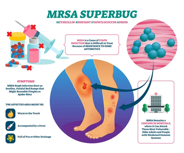 MRSA Super bug vector illustratie. Gelabelde Stafylokok infectie uitleggen schema. — Stockvector