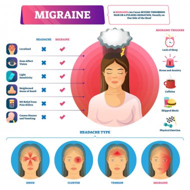 Migraine vector illustration. Labeled headache triggers and types scheme. clipart