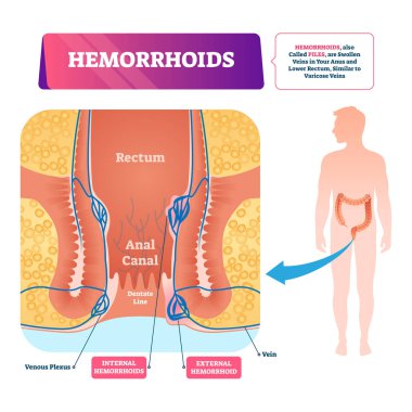 Hemoroid vektör Illustration. Etiketli anatomik vasküler kazık şeması.