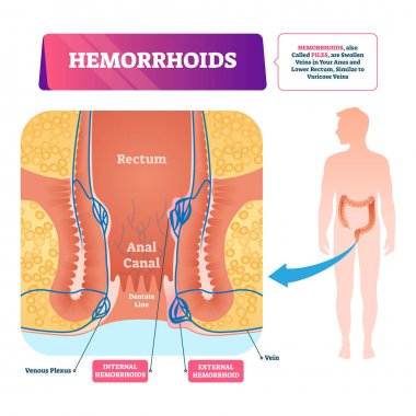 Hemorrhoids vector illustration. Labeled anatomical vascular piles scheme. clipart