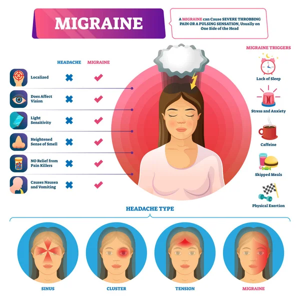 Migraine vector illustratie. Gelabelde hoofdpijn triggers en typen schema. — Stockvector