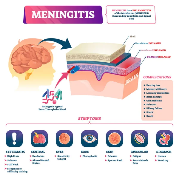 Meningitis vektor illustration. Märkt hjärn membran inflammation Scheme. — Stock vektor
