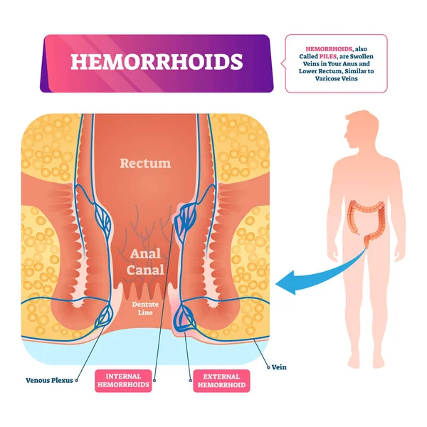 Illustrazione vettoriale delle emorroidi. Schema di pali vascolari anatomici etichettati . — Vettoriale Stock