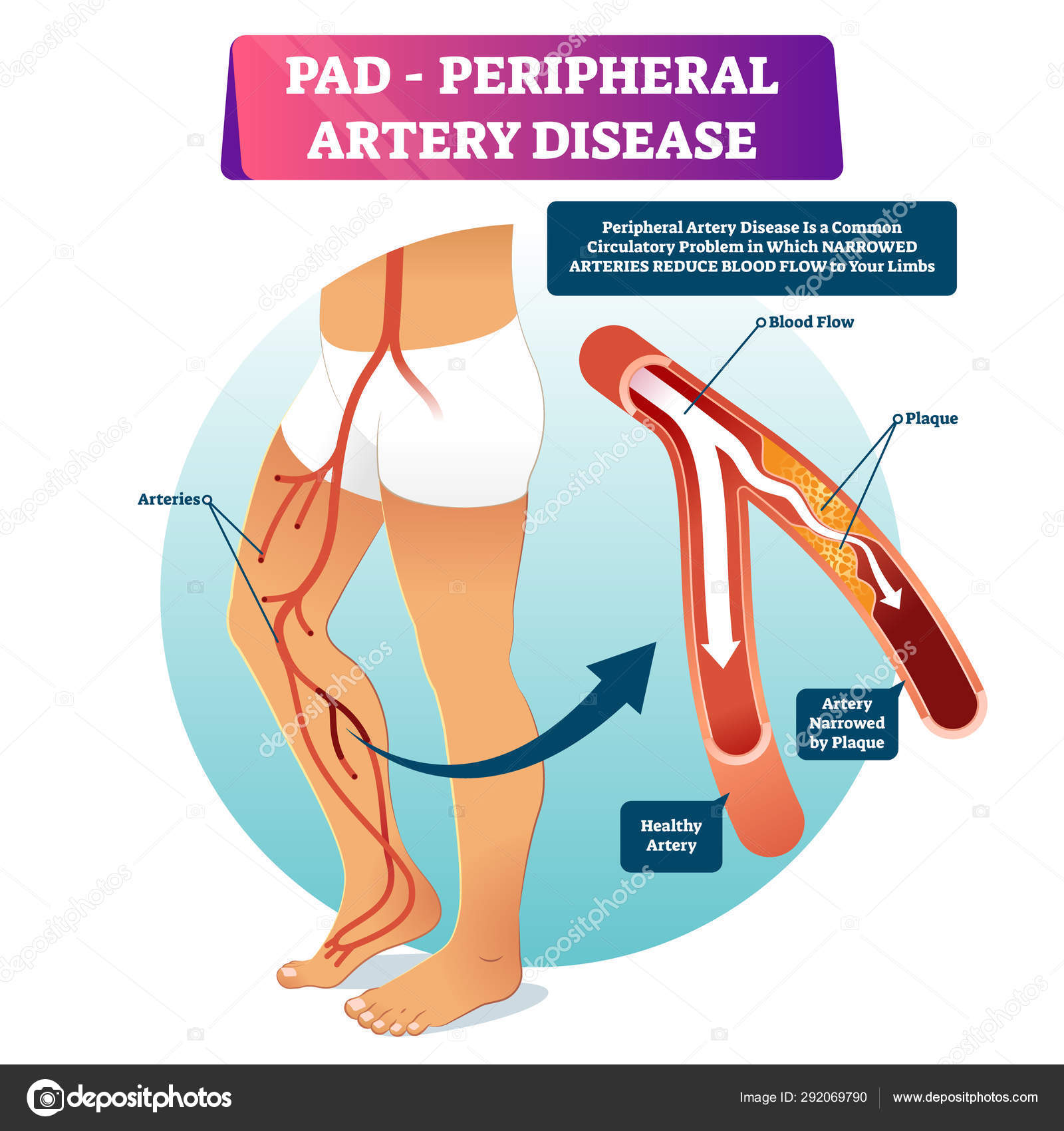 Peripheral artery disease PAD vector illustration. Labeled medical scheme. Stock Vector Image by ©VectorMine #292069790 Peripheral artery disease PAD vector illustration. Labeled medical scheme. Stock Vector Image by ©VectorMine #292069790