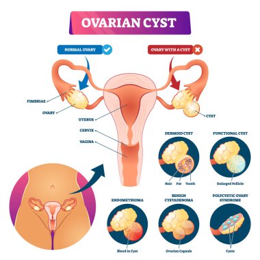 Yumurtalık kisti vektör illüstrasyon. Etiketli tıbbi durum tipleri şeması.