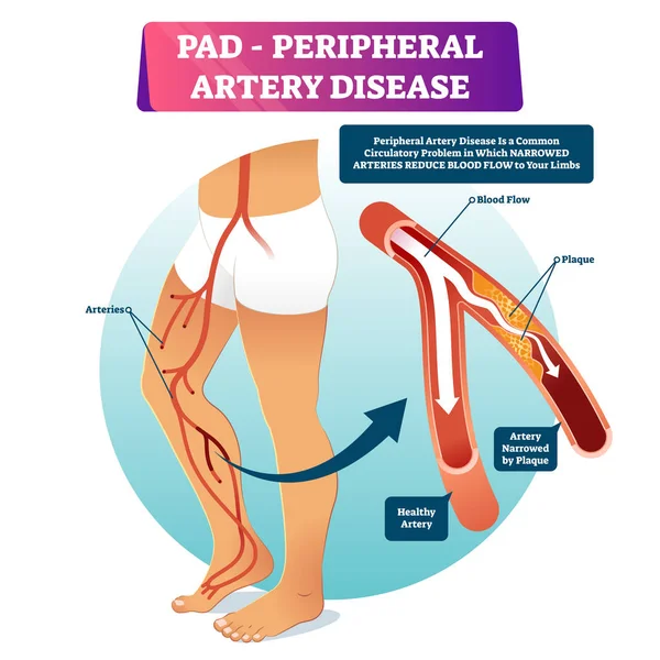 Perifer artärsjukdom pad vektor illustration. Märkt medicinskt system. — Stock vektor