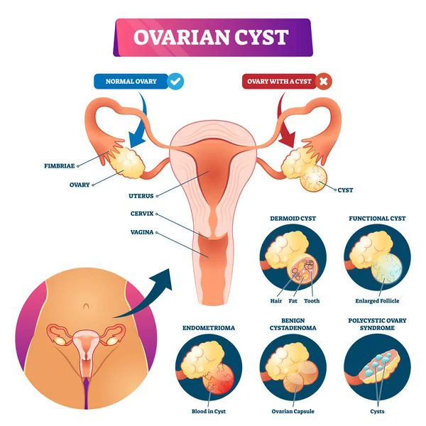 Ovarian cyst vector illustration. Labeled medical condition types scheme. — Stock Vector