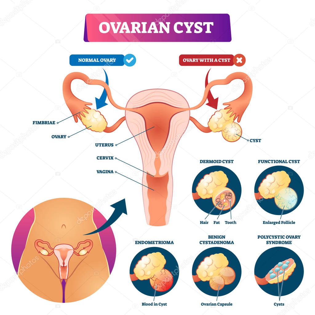 Ovarian cyst vector illustration. Labeled medical condition types scheme.
