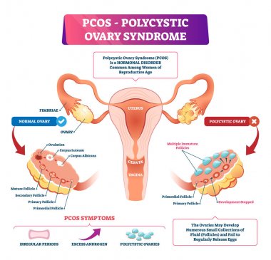 Polycystic ovary syndrome vector illustration. Labeled reproductive disease clipart