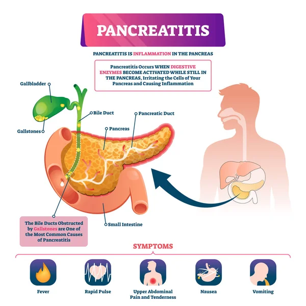 Pankreatit vektör illüstrasyon. Etiketli hasta pankreas iltihabı şeması — Stok Vektör