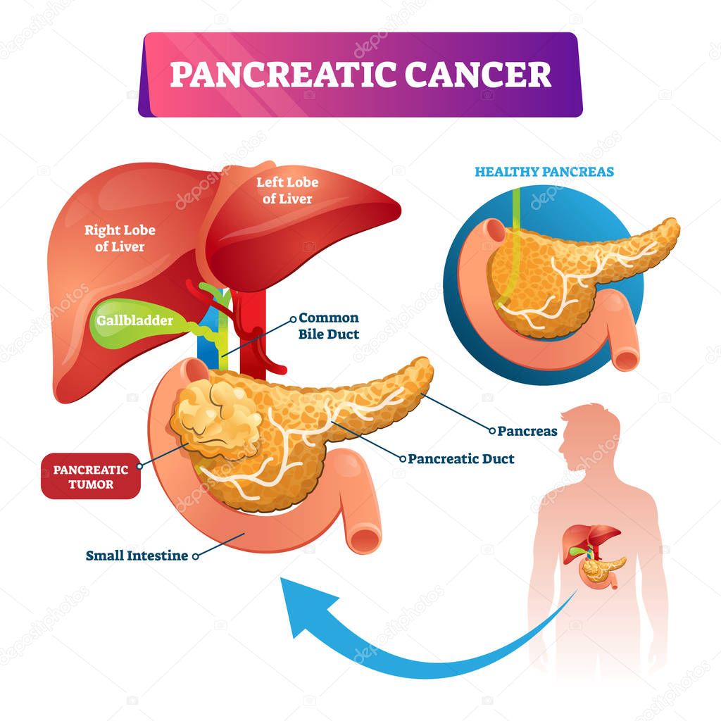 Pancreatic cancer vector illustration. Labeled ill stomach oncology disease