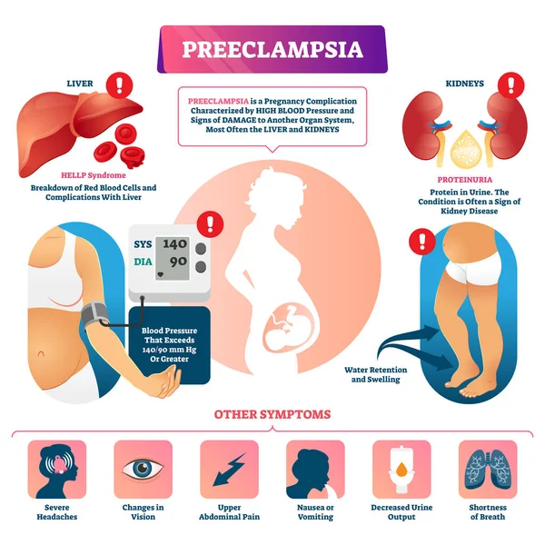 Illustration vectorielle de prééclampsie. Schéma de complication de grossesse étiqueté . — Image vectorielle