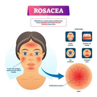 Rosacea vektör illüstrasyon. Etiketli kırmızı cilt sorunu açıklama şeması.