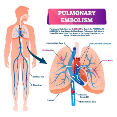 Pulmoner emboli vektör illüstrasyon. Etiketli akciğer kan tıkanıklığı şeması