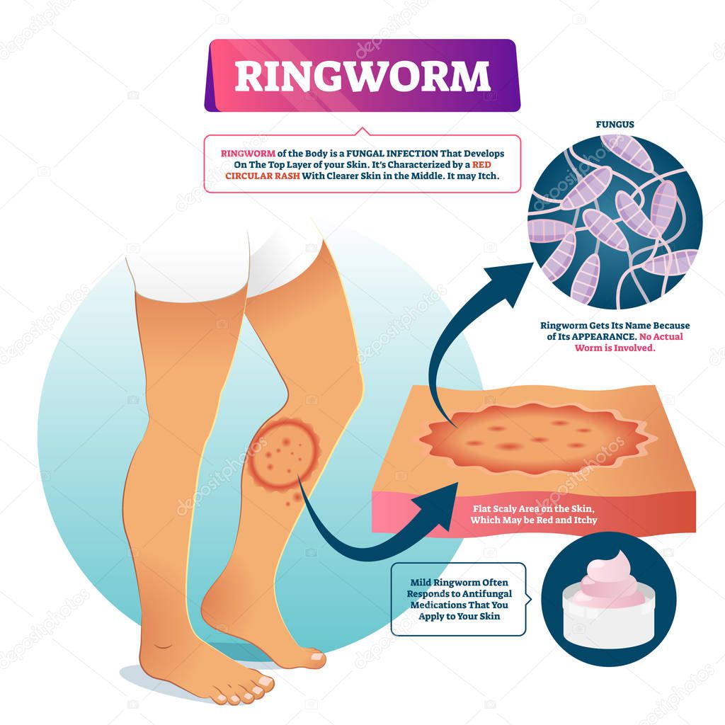 Ringworm vector illustration. Labeled fungal skin infection example scheme.