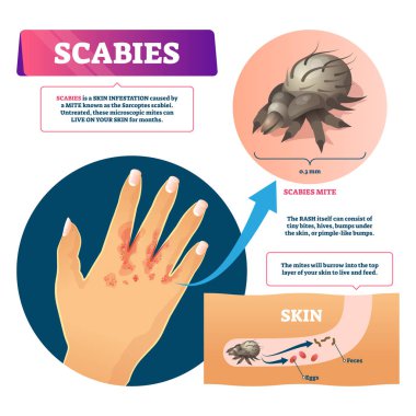 Scables vector illustration. Labeled educational skin infestation scheme. clipart