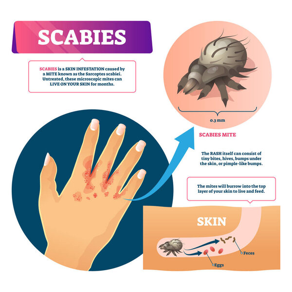 Scables vector illustration. Labeled educational skin infestation scheme.