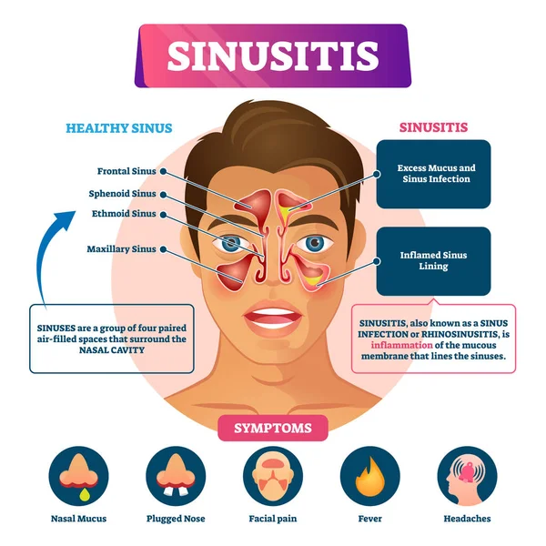 Sinüzit vektör illüstrasyonu. Etiketli rinosinüzit iltihabı şeması.