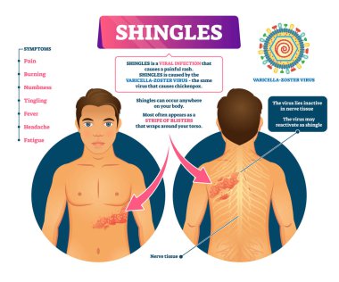 Shingles vector illustration. Labeled medical skin virus explanation scheme clipart
