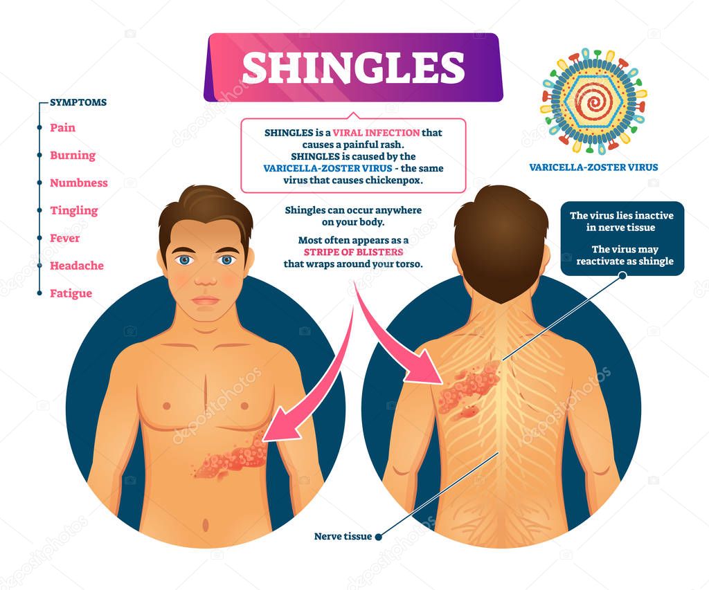 Shingles vector illustration. Labeled medical skin virus explanation scheme